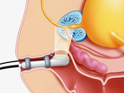 Puncture biopsy of the prostate gland