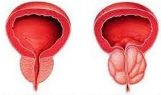 Healthy prostate and inflamed