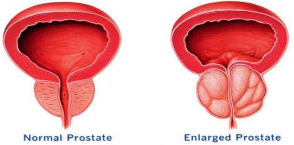 Normal prostate, inflamed prostate